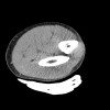 SPORK, NICO - 22.03.1976 - 02.08.2022 - CT obere Extremität - 17:56:57